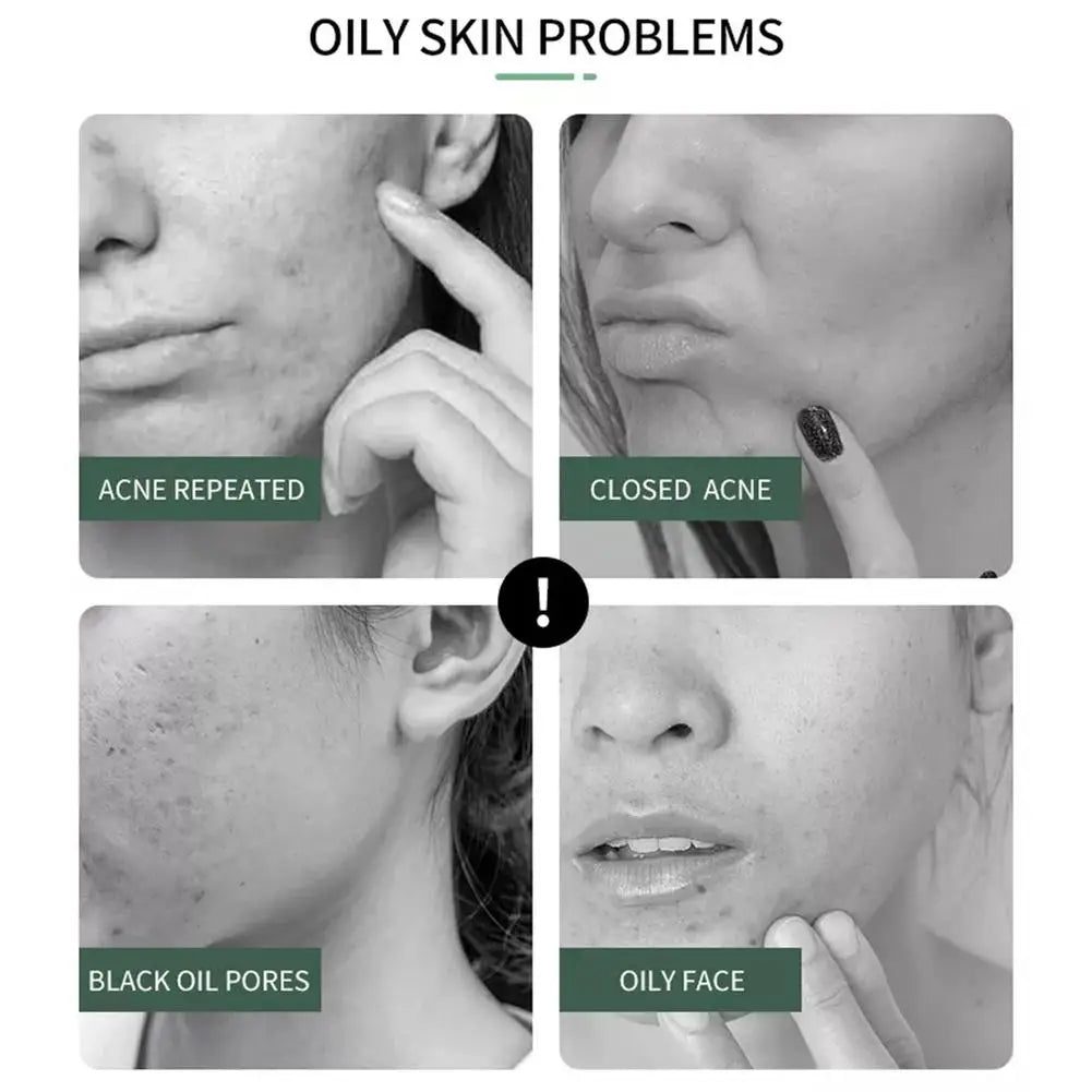 20g Salicylic Acid Shrink Pores Face Cream  Acne Removal Cream Acne Treatment Oil Control Whitening Moisturize Skin Care