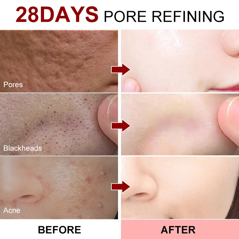 Remove Large Pores Serum Lactic Acid Facial Pore Shrinking Repairing Product Pore Minimizing Firming Smooth Korean Skin Care New